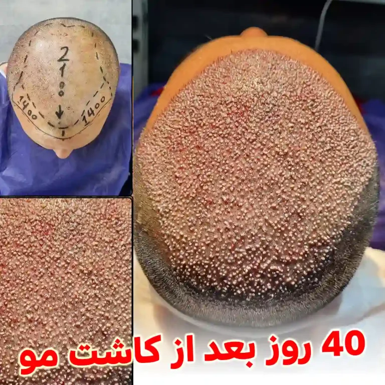 40-days-after-hair-transplant
