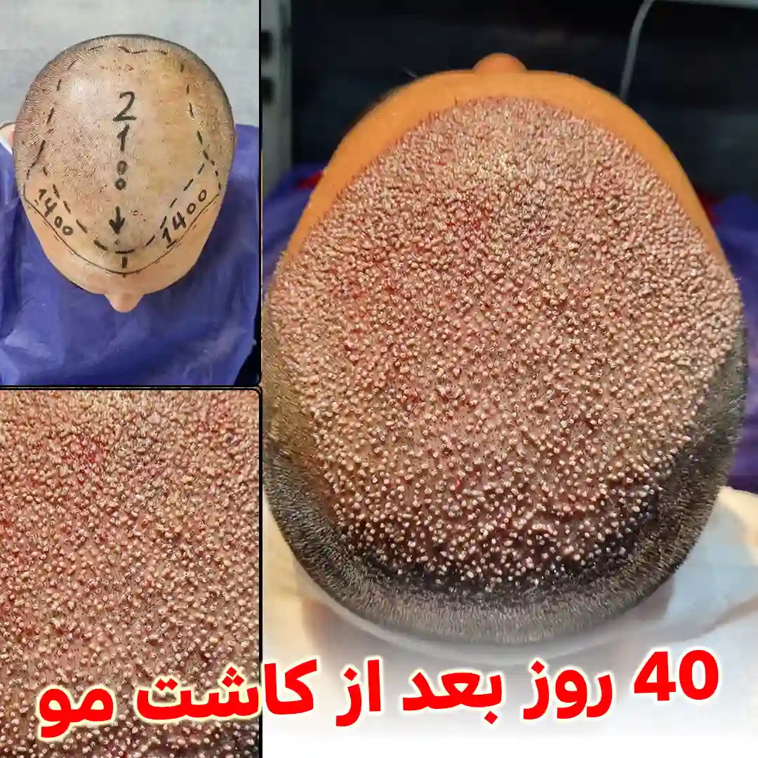 ۴۰ روز بعد از کاشت مو – کلینیک دکتر نیک