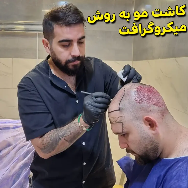 Hair-transplant-by-micrograft-method
