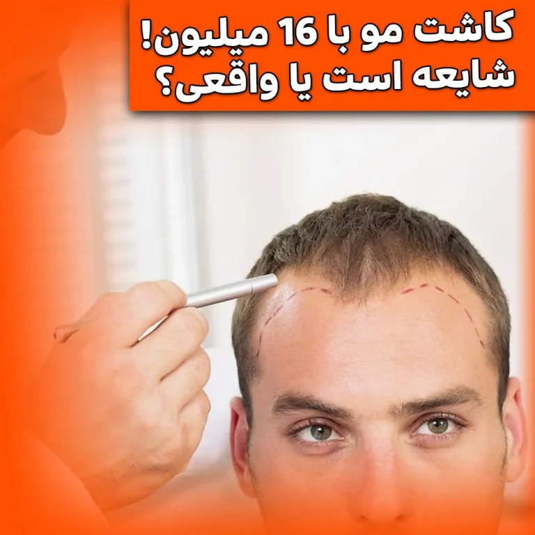Hair-transplant-for-16-million-Is-it-a-rumor-or-real