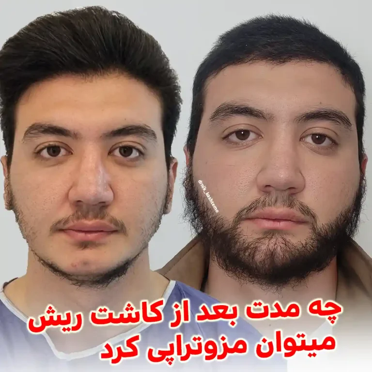 How-long-after-a-beard-transplant-can-mesotherapy-be-done
