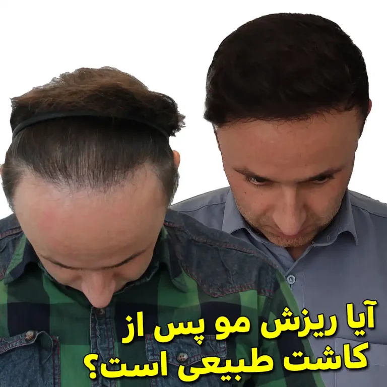 Is-hair-loss-normal-after-transplantation