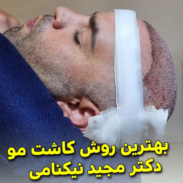 The-best-hair-transplant-method