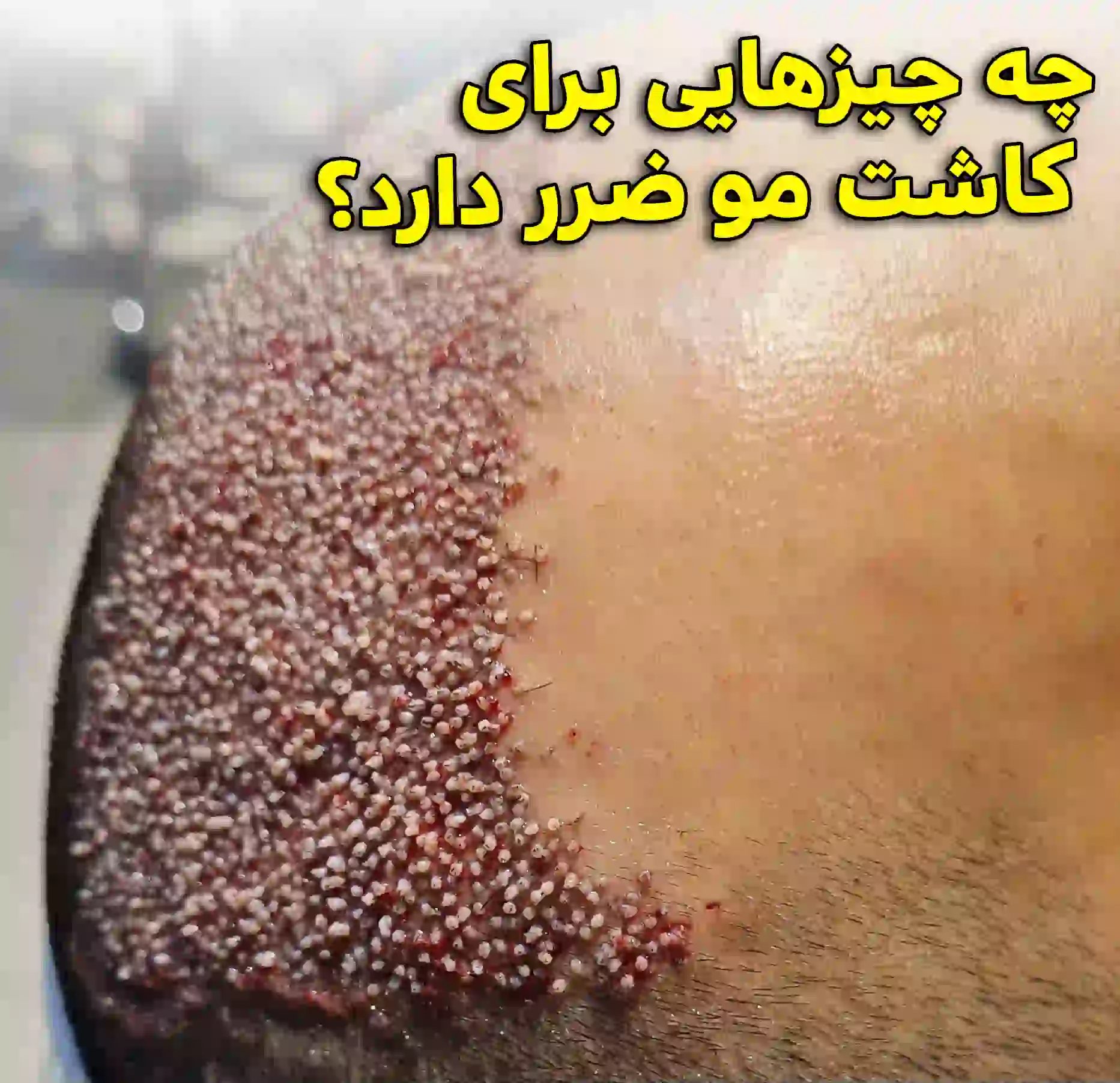 چه چیزهایی برای کاشت مو ضرر دارد؟ کلینیک دکتر نیک