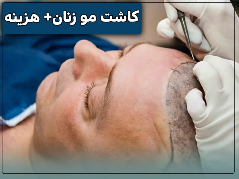 Womens-hair-transplant-cost