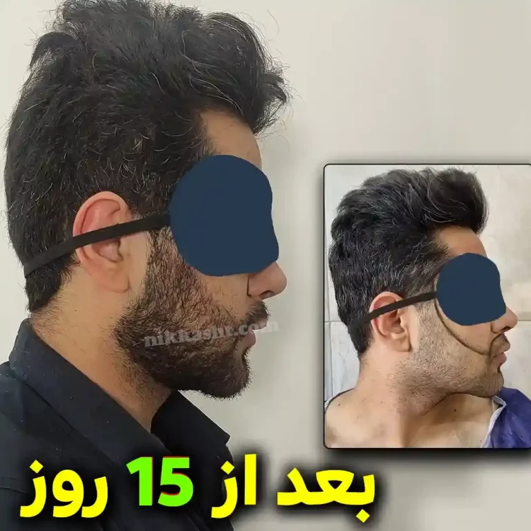 beardtransplant58745