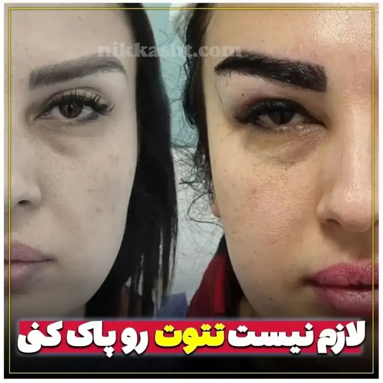 eyebrowsestransplant