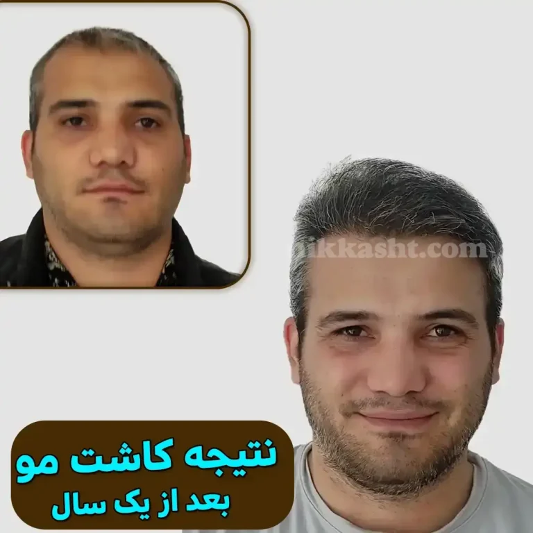 hairstyle1transplant
