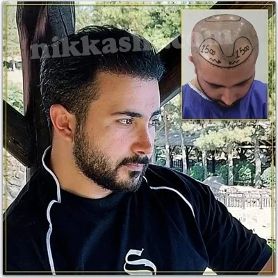 hairtransplantdrnk999